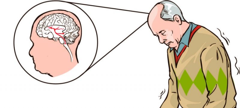 Sintomas distintos da doença de Parkinson ligados a diferentes caminhos do cérebro